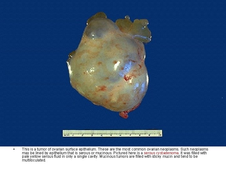  • This is a tumor of ovarian surface epithelium. These are the most