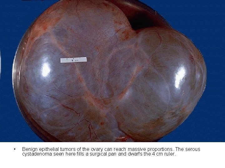 • Benign epithelial tumors of the ovary can reach massive proportions. The serous • Benign epithelial tumors of the ovary can reach massive proportions. The serous