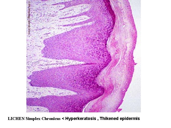 LICHEN Simplex Chronicus < Hyperkeratosis , Thikened epidermis LICHEN Simplex Chronicus < Hyperkeratosis , Thikened epidermis