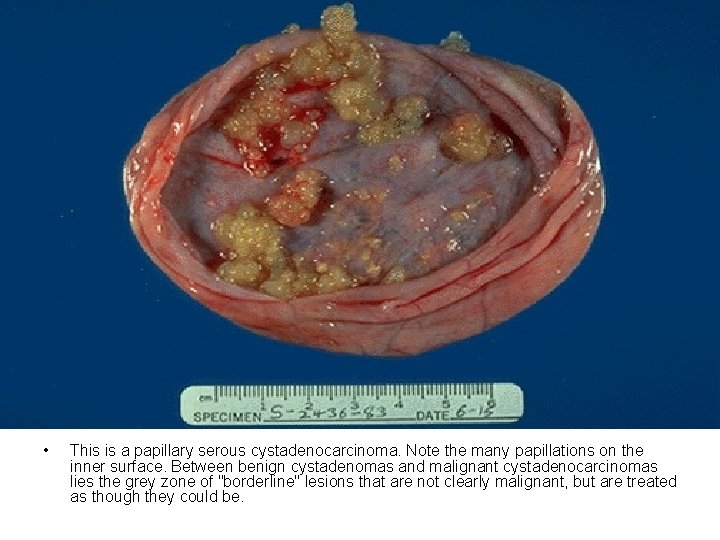  • This is a papillary serous cystadenocarcinoma. Note the many papillations on the