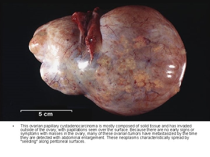 • This ovarian papillary cystadenocarcinoma is mostly composed of solid tissue and has