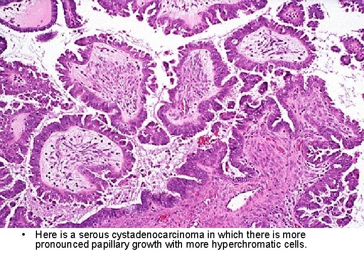  • Here is a serous cystadenocarcinoma in which there is more pronounced papillary