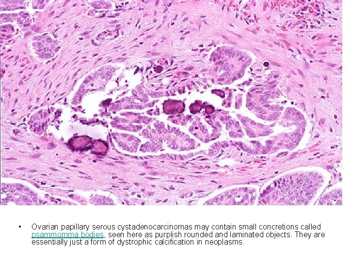  • Ovarian papillary serous cystadenocarcinomas may contain small concretions called psammomma bodies, seen