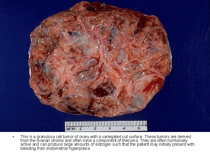  • This is a granulosa cell tumor of ovary with a variegated cut