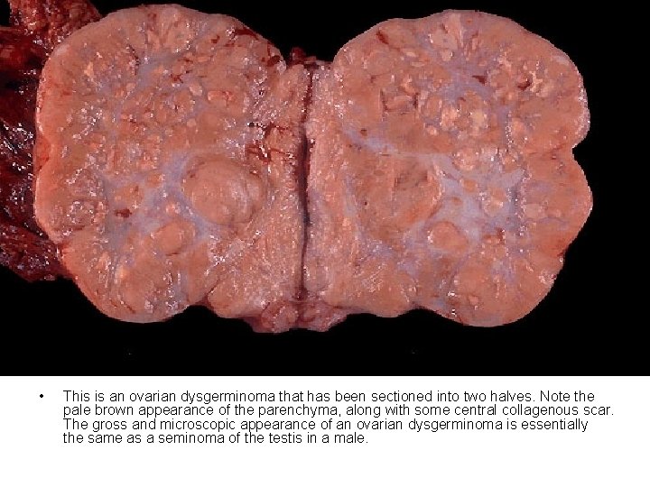  • This is an ovarian dysgerminoma that has been sectioned into two halves.