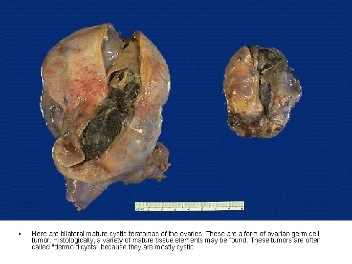 • Here are bilateral mature cystic teratomas of the ovaries. These are a • Here are bilateral mature cystic teratomas of the ovaries. These are a