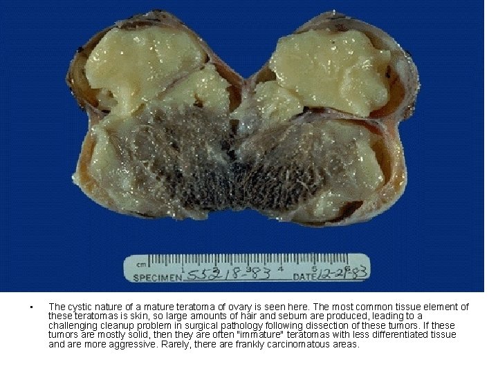  • The cystic nature of a mature teratoma of ovary is seen here.