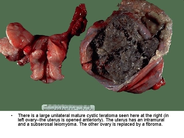 • There is a large unilateral mature cystic teratoma seen here at the • There is a large unilateral mature cystic teratoma seen here at the