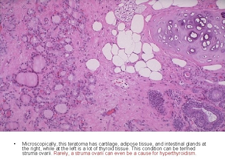 • Microscopically, this teratoma has cartilage, adipose tissue, and intestinal glands at the • Microscopically, this teratoma has cartilage, adipose tissue, and intestinal glands at the