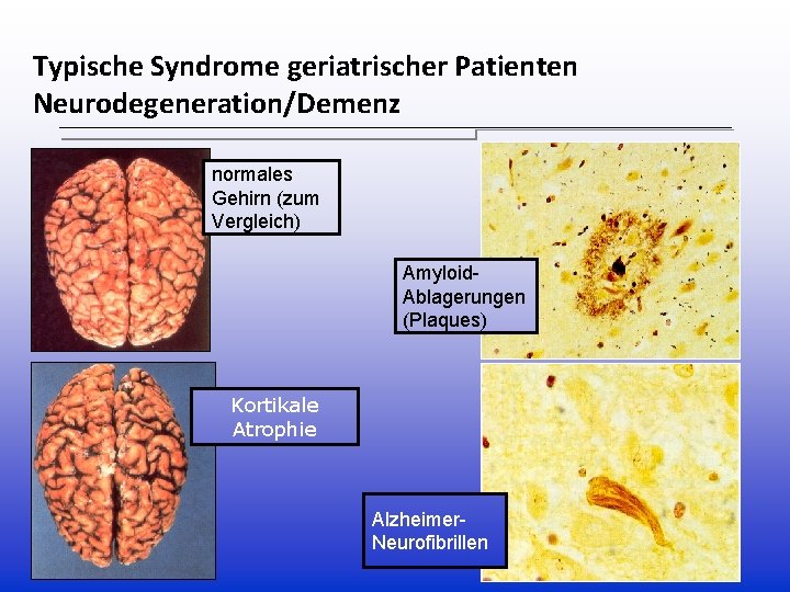Typische Syndrome geriatrischer Patienten Neurodegeneration/Demenz normales Gehirn (zum Vergleich) Amyloid. Ablagerungen (Plaques) Kortikale Atrophie Typische Syndrome geriatrischer Patienten Neurodegeneration/Demenz normales Gehirn (zum Vergleich) Amyloid. Ablagerungen (Plaques) Kortikale Atrophie