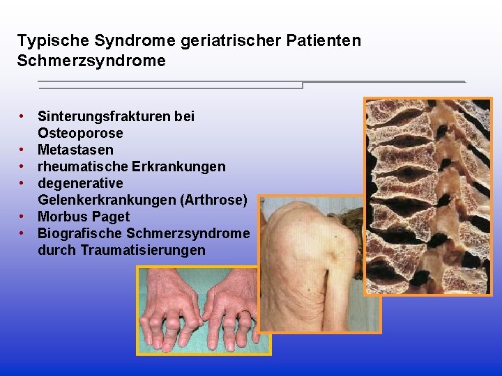Typische Syndrome geriatrischer Patienten Schmerzsyndrome • Sinterungsfrakturen bei Osteoporose • Metastasen • rheumatische Erkrankungen Typische Syndrome geriatrischer Patienten Schmerzsyndrome • Sinterungsfrakturen bei Osteoporose • Metastasen • rheumatische Erkrankungen