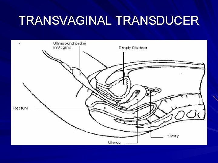 TRANSVAGINAL TRANSDUCER 