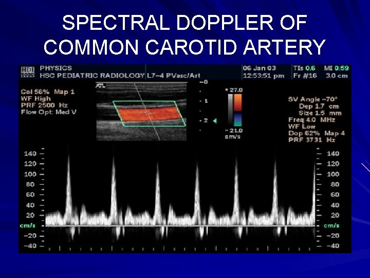 SPECTRAL DOPPLER OF COMMON CAROTID ARTERY 