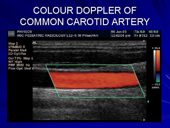 COLOUR DOPPLER OF COMMON CAROTID ARTERY 