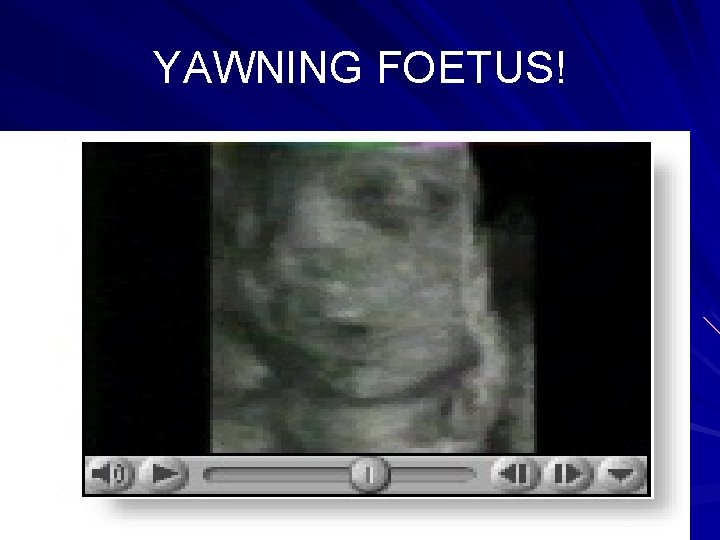 YAWNING FOETUS! 