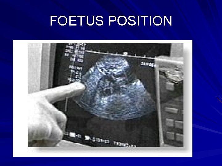 FOETUS POSITION 