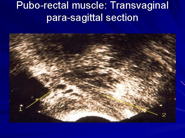 Pubo-rectal muscle: Transvaginal para-sagittal section 