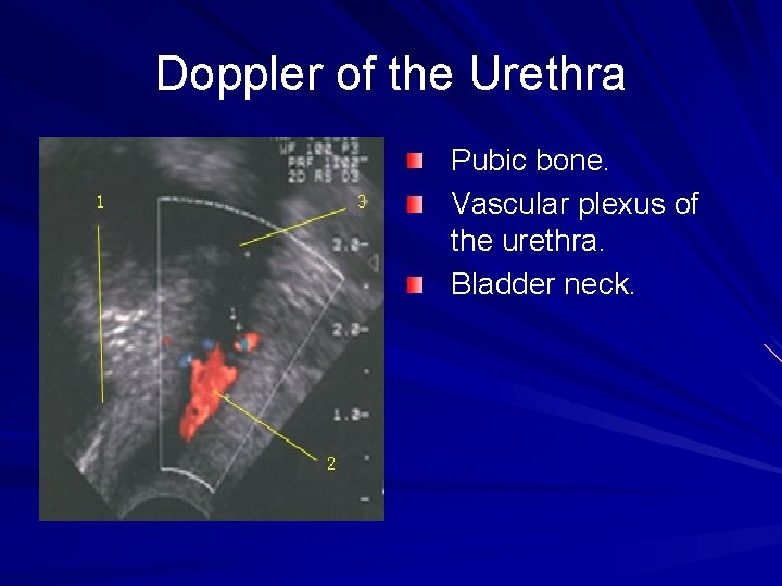 Doppler of the Urethra Pubic bone. Vascular plexus of the urethra. Bladder neck. 