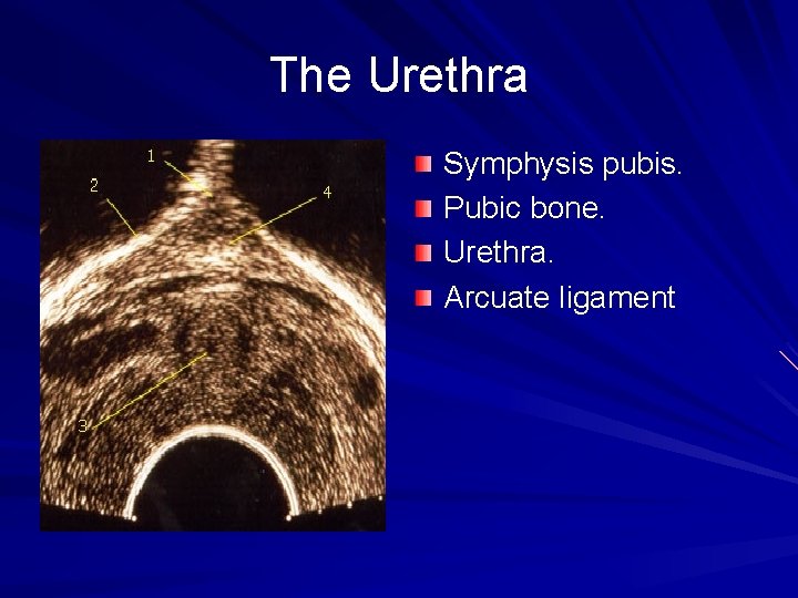 The Urethra Symphysis pubis. Pubic bone. Urethra. Arcuate ligament 