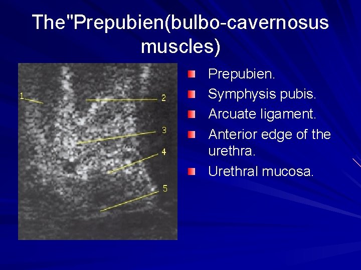 The"Prepubien(bulbo-cavernosus muscles) Prepubien. Symphysis pubis. Arcuate ligament. Anterior edge of the urethra. Urethral mucosa.