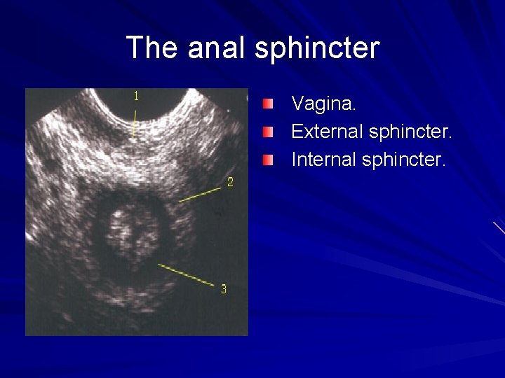 The anal sphincter Vagina. External sphincter. Internal sphincter. 