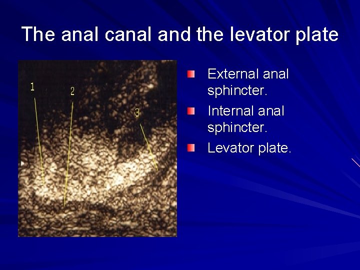 The anal canal and the levator plate External anal sphincter. Internal anal sphincter. Levator