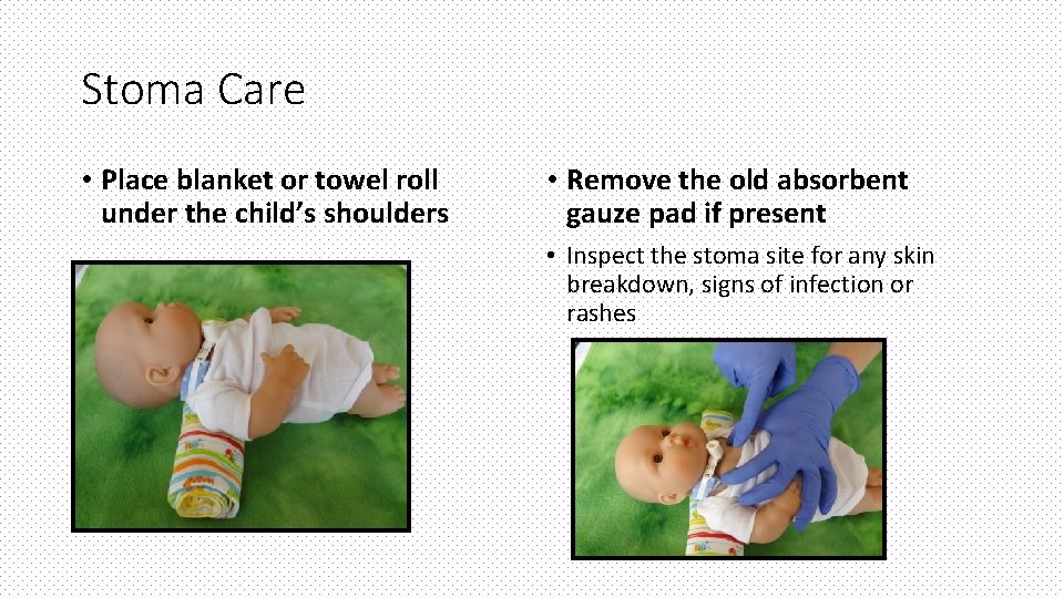 Stoma Care • Place blanket or towel roll under the child’s shoulders • Remove