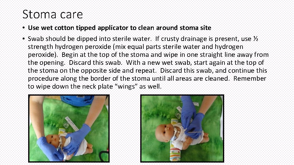 Stoma care • Use wet cotton tipped applicator to clean around stoma site •