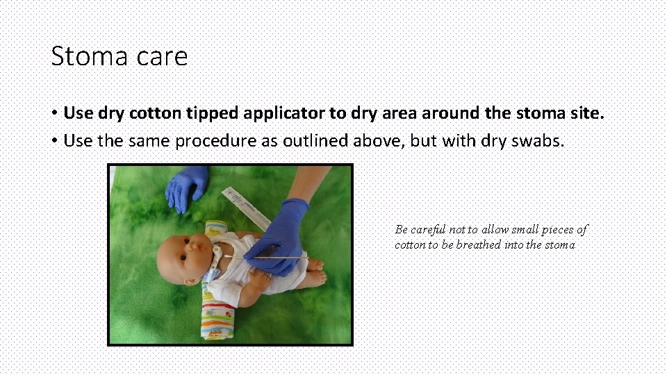 Stoma care • Use dry cotton tipped applicator to dry area around the stoma