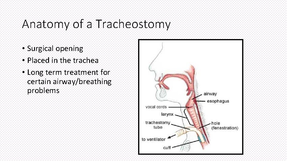 Anatomy of a Tracheostomy • Surgical opening • Placed in the trachea • Long