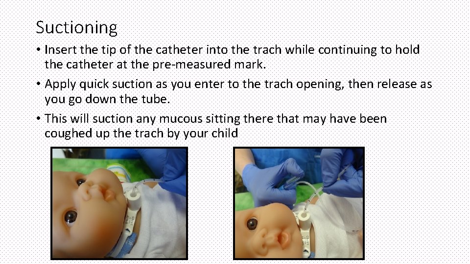 Suctioning • Insert the tip of the catheter into the trach while continuing to