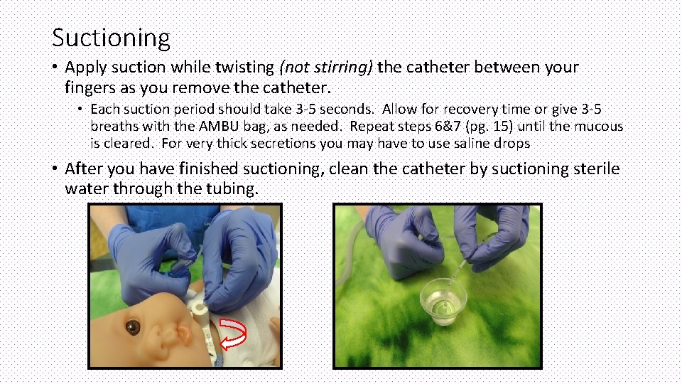 Suctioning • Apply suction while twisting (not stirring) the catheter between your fingers as