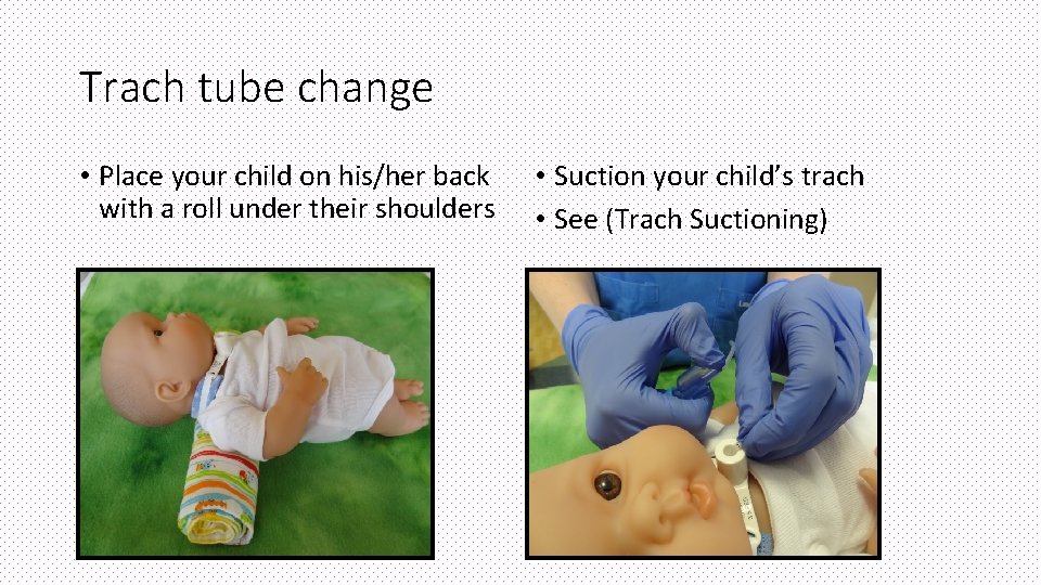 Trach tube change • Place your child on his/her back with a roll under