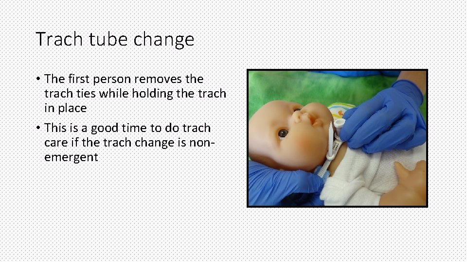 Trach tube change • The first person removes the trach ties while holding the