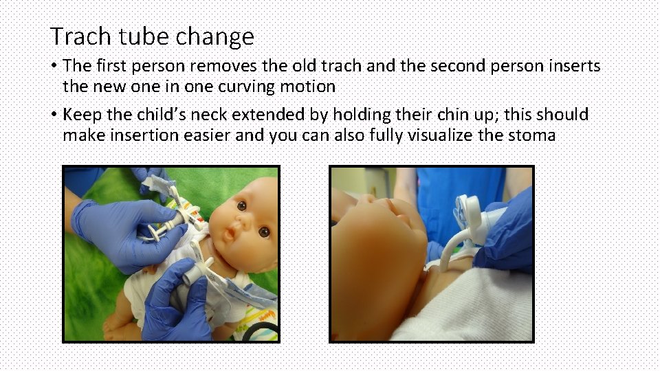 Trach tube change • The first person removes the old trach and the second