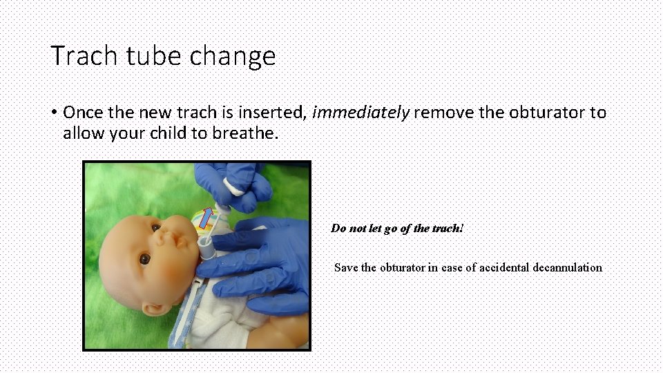 Trach tube change • Once the new trach is inserted, immediately remove the obturator