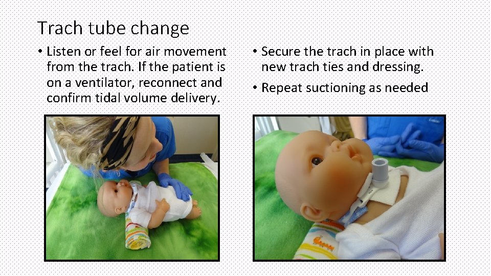 Trach tube change • Listen or feel for air movement from the trach. If