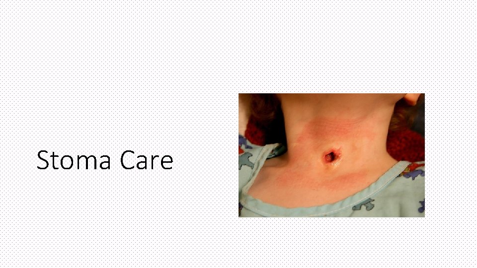 Stoma Care 