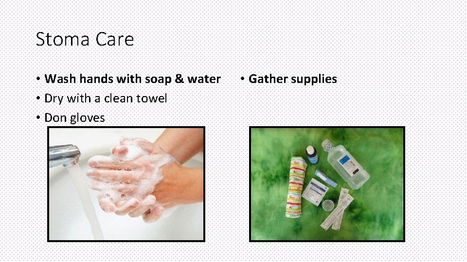 Stoma Care • Wash hands with soap & water • Dry with a clean