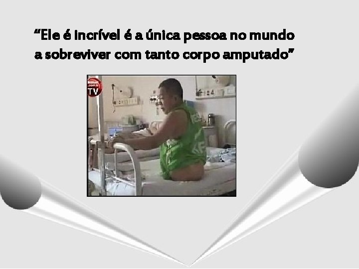 “Ele é incrível é a única pessoa no mundo a sobreviver com tanto corpo