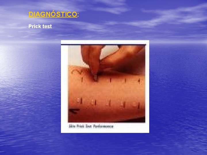 DIAGNÓSTICO: Prick test 