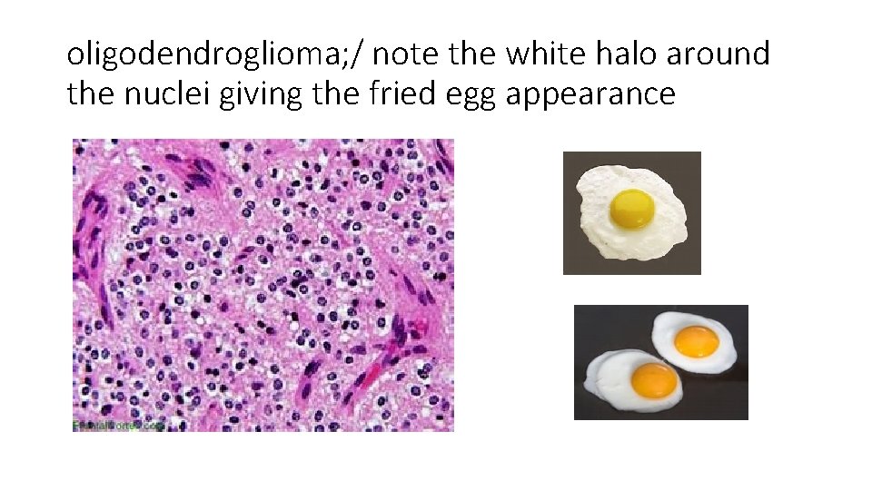 oligodendroglioma; / note the white halo around the nuclei giving the fried egg appearance