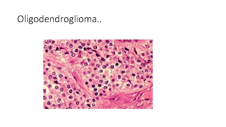 Oligodendroglioma. . Oligodendroglioma. .