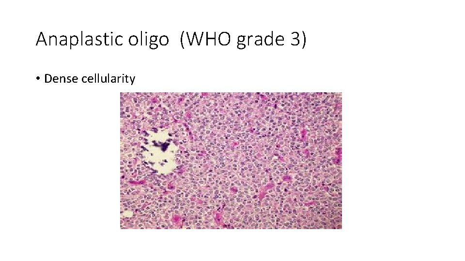 Anaplastic oligo (WHO grade 3) • Dense cellularity 