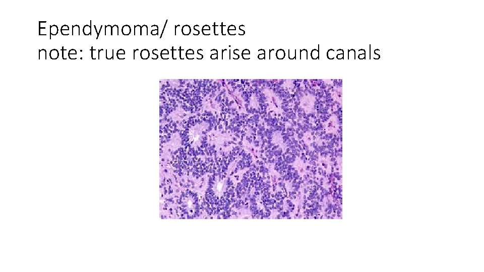 Ependymoma/ rosettes note: true rosettes arise around canals 