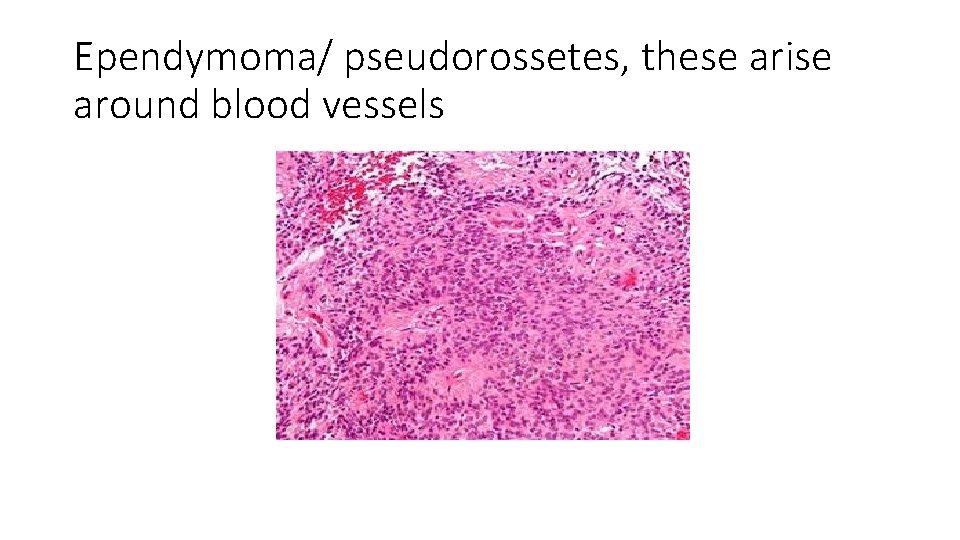 Ependymoma/ pseudorossetes, these arise around blood vessels 