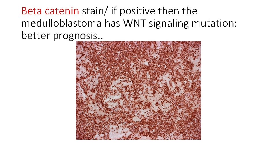 Beta catenin stain/ if positive then the medulloblastoma has WNT signaling mutation: better prognosis.