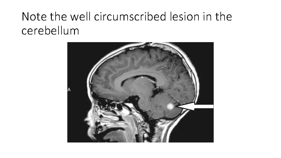 Note the well circumscribed lesion in the cerebellum 