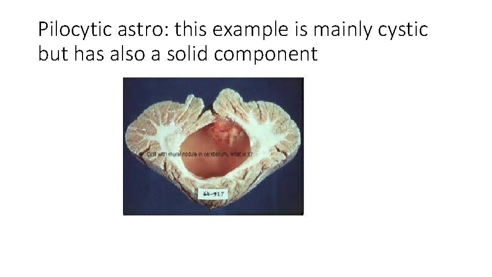 Pilocytic astro: this example is mainly cystic but has also a solid component 