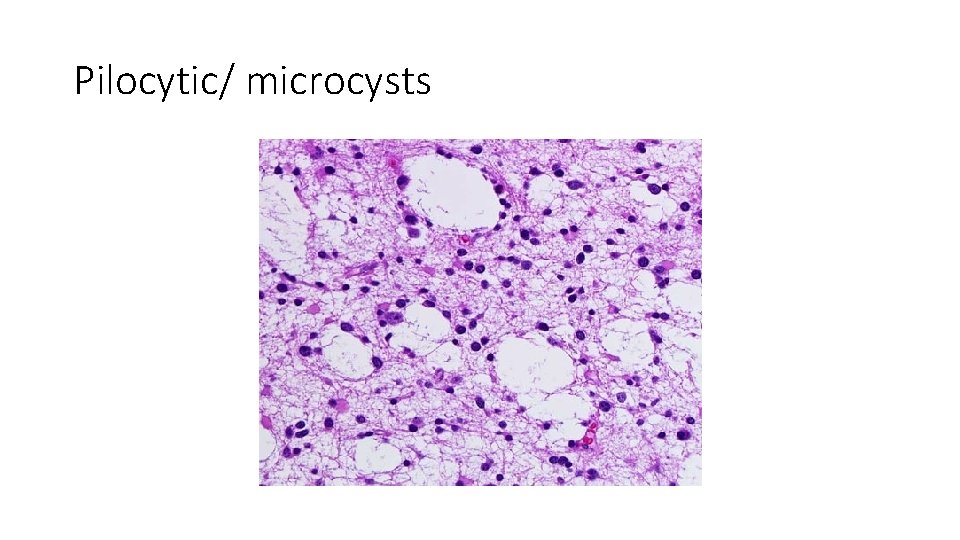 Pilocytic/ microcysts 